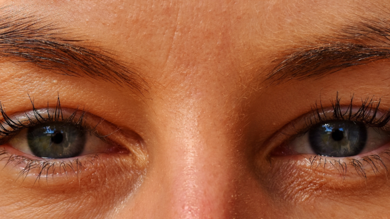 What Is Dry Eye? Symptoms, Causes, and Treatment